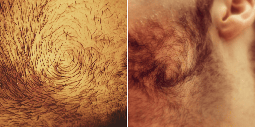 Close-up images of beard cowlicks: the left image shows a tight, circular growth pattern under the chin, while the right image highlights a pronounced swirl near the jawline.