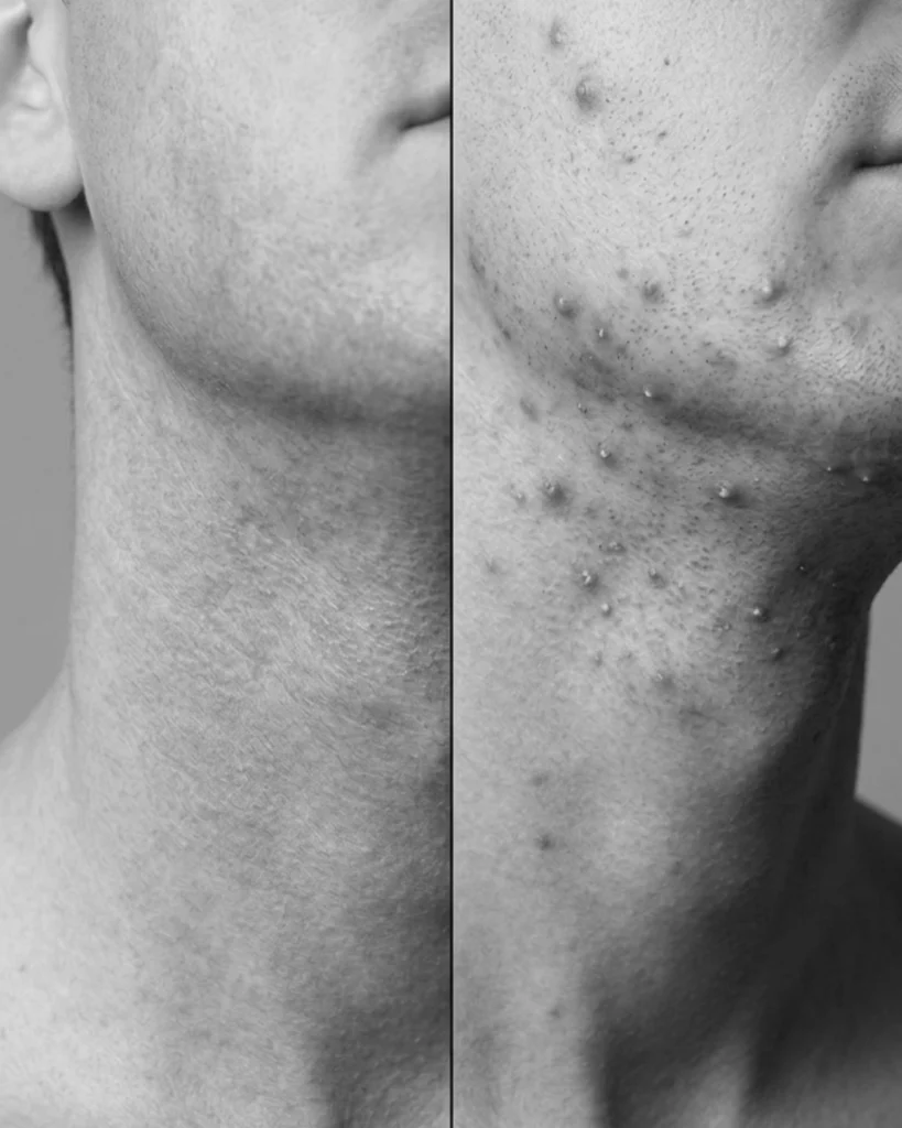 Split image comparing broad razor burn redness with raised razor bumps on the neck and jawline