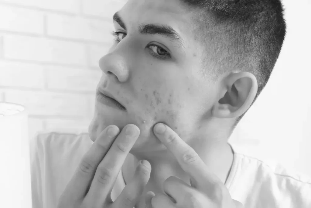 Young man with acne and redness showing the skin issues a beard can help cover